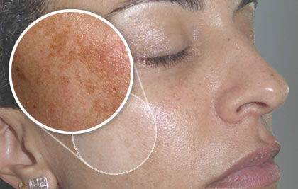 Melasma