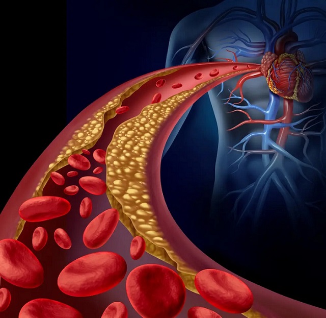 aterosclerosis-enfermedad