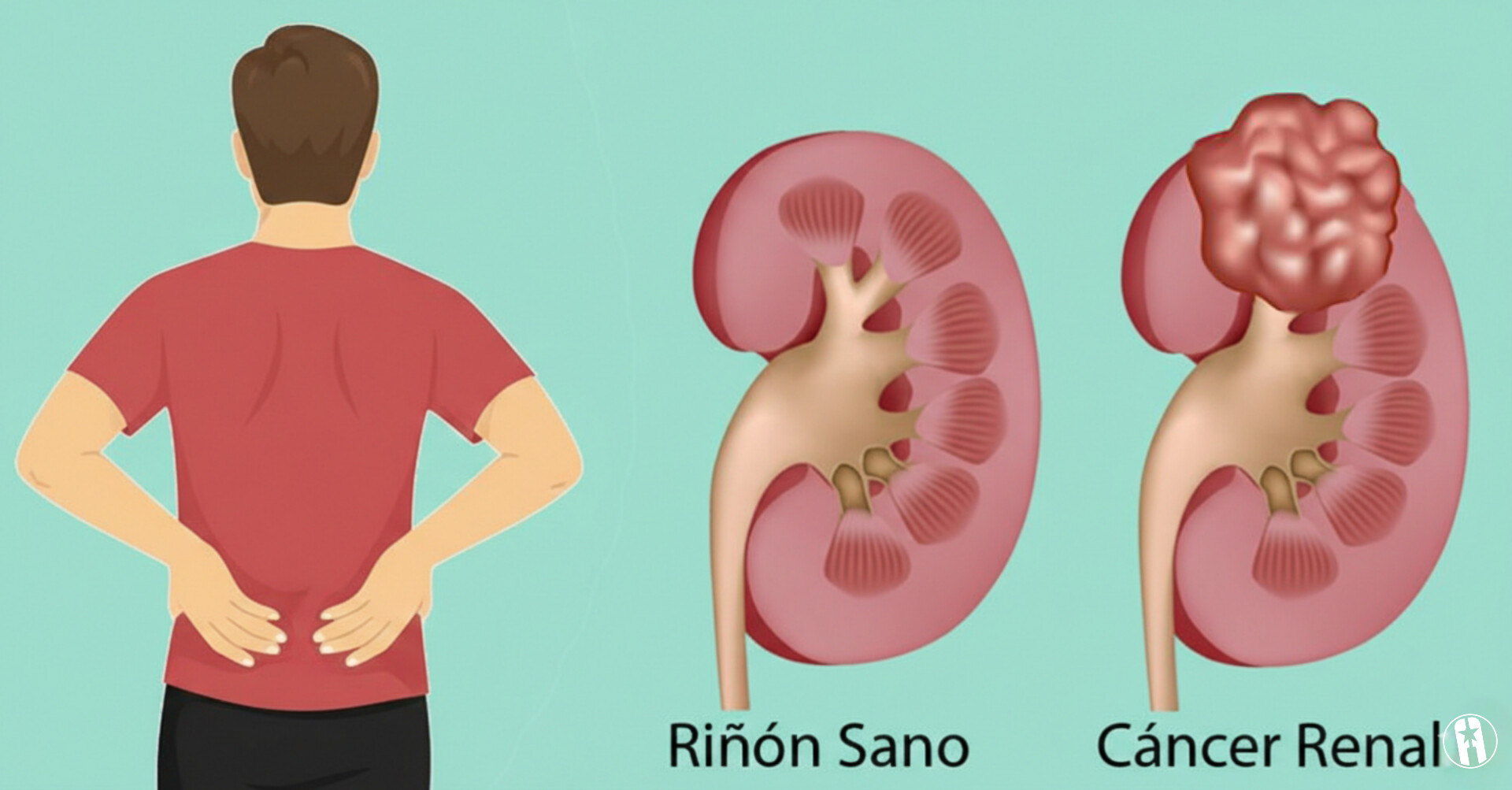 Cáncer de riñón Cáncer de riñón
